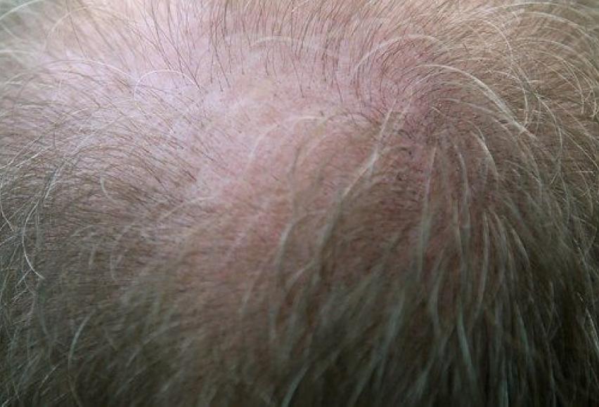 Stress Related Hair Loss and Will My Hair Grow Back  Cranial Prosthesis  Wigs